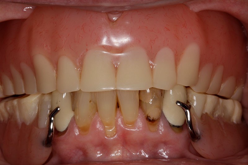 Permanent Dentures Jemison AL 35085